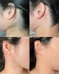 【うなじ＋もみあげワックス脱毛】袴姿/前撮り/ブライダルにマスト。圧倒的な品格と垢抜け。