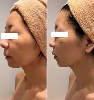 【小顔／むくみ／たるみ】小顔detoxフェイシャル