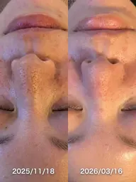 毛穴ハイドラフェイシャル