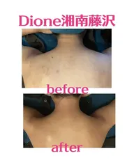 ☆キレイな背中〈脱毛×背中ニキビケア〉☆