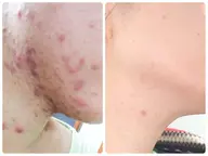 ニキビなのかニキビ跡なのか迷っている方✨肌荒れ相談歓迎🎊