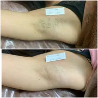 【✨人気No.1✨】両わき脱毛3回🌸夏キレイにしたい方は今がチャンス😤痛みはないのに効果ばっちり✨肌見せも怖くない✨