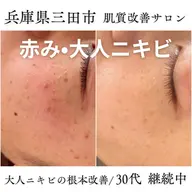 【毛穴詰まり•大人ニキビでお悩みの方】毛穴洗浄＋ハーブピーリングで肌質改善。ヘッドスパ、首肩凝りデコルテトリートメント付