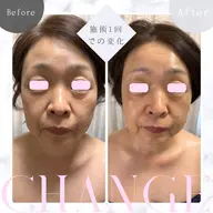 エイジングケアコース