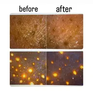 無料毛穴診断毛穴カウンセリング