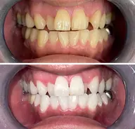 口コミご協力いただける方限定！歯科ホワイトニング20分3980円