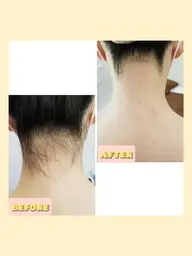 レディースうなじ🌿つるつる美肌脱毛