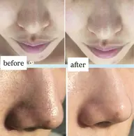 3月末日まで3名限定!お得な3回券《毛穴の黒ずみ改善》ピーリング+ハイドラ毛穴洗浄+保湿UPパック