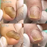 【分厚い爪・深爪補正】口コミにご協力頂ける方限定⭐︎1爪の補正✨恥ずかしくて隠していた爪😔💦綺麗に補正します🤗