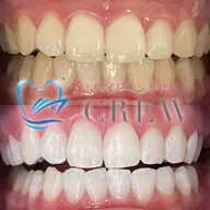 🦷minimo限定価格🦷12分×2照射 7500→2,500円❣️