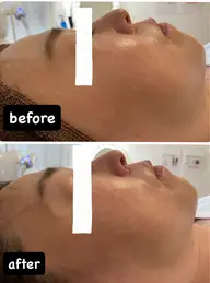 たるみ、二重アゴ撲滅キャンペーン