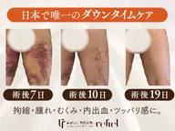 【モニター募集】　日本唯一のダウンタイムケア⭐︎ 脂肪吸引｜拘縮｜むくみ｜腫れ｜内出血