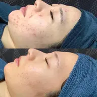 【即実感♪】生まれ変わる肌質!めくれない次世代ピーリング