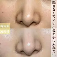 【お試し毛穴洗浄】鼻ハイドラ