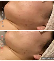 初回限定！ツルふわたまご肌✨剥離なし国産ハーブピーリング🌿ヘッド&パック付(マタニティok)