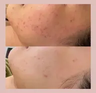 「美肌」ニキビ/毛穴ケア♪ターンオーバーを整え本来の美肌に ¥7900→¥4900