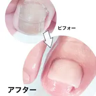 ☆フットのお悩み☆ トラブルネイルケア（1箇所）巻き爪ケア 陥入爪、肥厚爪、深爪の方へ丁寧なケア