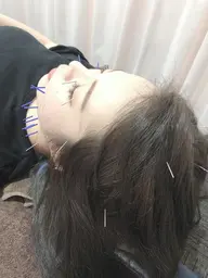 美容鍼(30本)＋遠赤ドーム