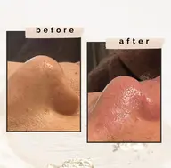 毛穴改善👃🏼ハイドラフェイシャル✨毛穴洗浄でざらついた肌や黒ずみを除去🫧清潔感UP🩷LEDドーム付き💡