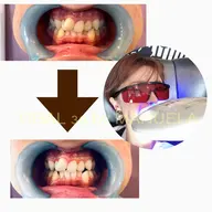 初めてのセルフホワイトニング