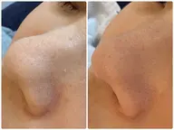 毛穴洗浄フェイシャル