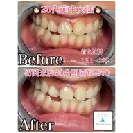 《初回限定》未経験の方、まずは試して見たい方にオススメ★ハイパワーセルフホワイトニング〈15分×2回照射〉