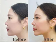 ❣️即実感❣️小顔リフトアップ機器 8000shot💄