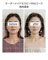 小顔矯正【左右差／たるみ改善】顔メニュー人気No.1