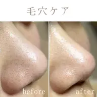 【毛穴改善／７５分】毛穴の黒ずみ／角栓／開き毛穴／たるみ毛穴／あらゆる毛穴のお悩み解消