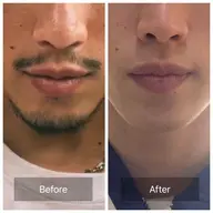 【プラチナビーム脱毛】髭脱毛1回（メンズ）