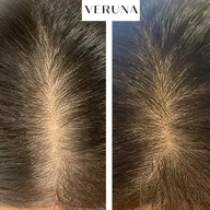 髪・頭皮の悩みにスカルプ棘ケア(生え際、分け目、頭頂部)＋ドライヘッドスパ20分