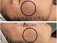 凸凹頬徹底ケアコース【頬のニキビ凸凹クレーター跡をしっかりケア】　5500円（６０５０）