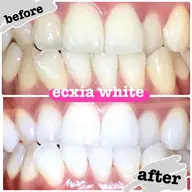 【定額通い放題】★セルフホワイトニング月額1万円の通い放題★