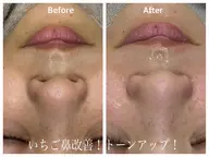 🟡毛穴に更に特化したセットメニュー【マツヤニパック✖️毛穴侍】※パッチテスト済みの方