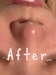 毛穴洗浄フェイシャル