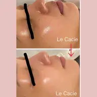 【くすみ、色むら、シミ改善】トラネキサム酸&グルタチオン★ポレーション導入フェイシャル/深層ピーリング付き