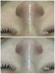 日にち、時間限定！ハイドラフェイシャル★【頑固な黒ずみごっそり！】毛穴洗浄×ヒト幹細胞＆ラジオ波