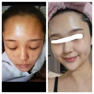 ニキビでお悩みの方限定✨️ニキビの原因を改善!