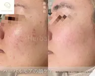 【春限定/お試し】ハーブピーリング+毛穴洗浄 ✨¥33,000→¥5,980