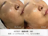 【シミ、シワの集中ケア】最新韓国施術!XE LHAピール💎シミ改善、シワケア、色素沈着、ニキビケア、毛穴の黒ずみにも!