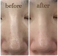 毛穴撲滅メニュー💙肌負担なし!!ピーリング&毛穴洗浄🫧超音波で毛穴の奥の汚れまで掻き出してむき卵肌に🥚