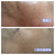 【メンテナンス】光シャワー又は水光ピーリング