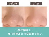 【毛穴洗浄】鼻ハイドロフェイシャル｜黒ずみ・角栓除去