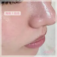 ＜4/9(木)限定＞キャンペーン🌷通常価格¥16,500→¥4,９00でご案内！【毛穴＋美容液導入コース】