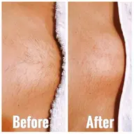 【シュガーリング 】VIO