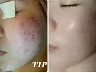 剥離なし国産ハーブ‼️TIPハーブピーリングメディエーション🌿【ミニモ限定特別価格】（60分）