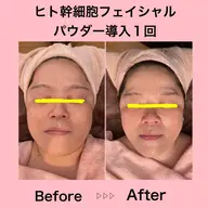 ヒト幹細胞フェイシャルパウダー導入コース