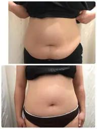 新ミニモ限定メニュー❣️ 光痩身（片面）&キャビ、ラジオ波、EMS で脂肪撃退コース70分4900円）地域最安値）