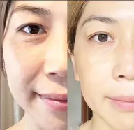 モニター価格⭐　リフトアップ/乾燥肌/ニキビ肌/お肌のお悩み⭐肌改善/臍帯由来&エラスチン　水光噴射