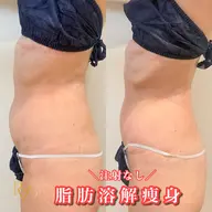 【お腹集中🔥がっつり痩身】針を使わない脂肪撃退剤導入‼️最新マシン×強力デトックスマッサージ/ぽっこりお腹/便秘解消